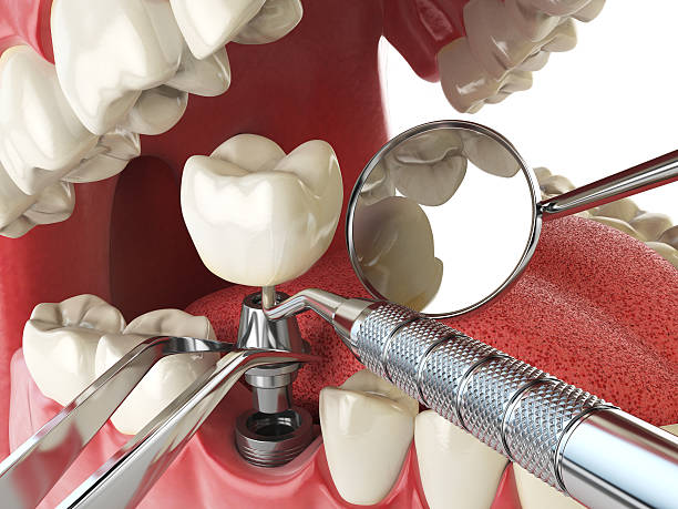 Best Dentist for Tooth Abscess  in De Graff, OH